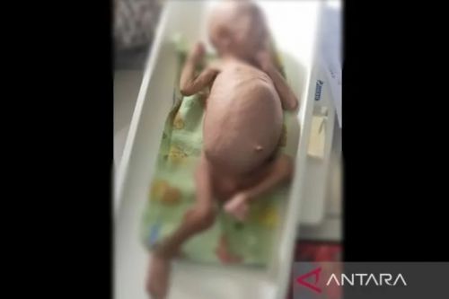 Seorang bayi di Karawang mengalami gizi buruk dan menderita penyakit atresia bilier. (ANTARA/Tangkap Layar WAG)